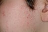 Laser Acne Treatment