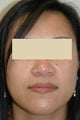 Laser Acne Treatment