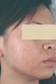 Laser Acne Treatment