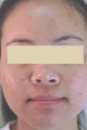 Laser Acne Treatment