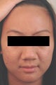 Laser Acne Treatment