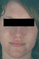 Acne Laser Treatment