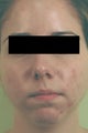 Acne Laser Treatment