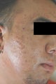 Acne Laser Treatment