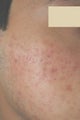 Laser Acne Treatment