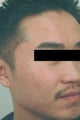 Acne Laser Treatment