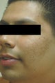 Acne Laser Treatment