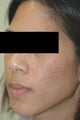 Acne Laser Treatment