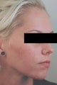 Acne Laser Treatment