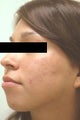 Acne Laser Treatment