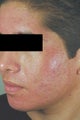 Laser Acne Treatment