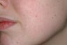 Acne treatment