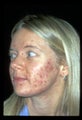 Acne Treatment