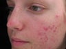 PDT for acne treatment