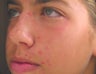 Acne treatment