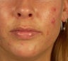 PDt for acne treatment
