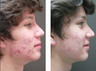 Acne Treatment
