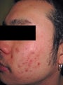 Laser Acne Treatment