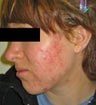 Laser Acne Treatments
