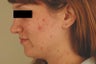 Laser Acne Treatment
