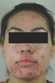 Laser Acne Treatment