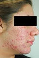 Laser Acne Treatment