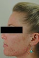 Laser Acne Treatment
