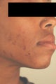 Laser Acne Treatment