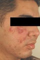 Laser Acne Treatment