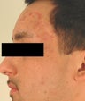 Laser Acne Treatment