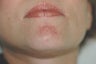 Laser Acne Treatment
