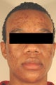 Laser Acne Scar Removal