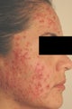 Laser Acne Treatment