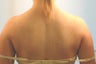 Laser Back Acne Treatment