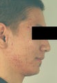 Laser Acne Treatment