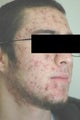 Laser Acne Treatment