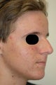 Huntington Beach Acne Treatment Before and After