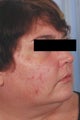 Laser Acne Treatment