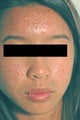 Laser Acne Treatment
