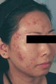 Laser Acne Treatment