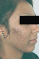 Laser Acne Treatment