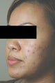 Laser Acne Treatment