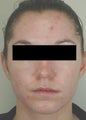Laser Acne Treatment
