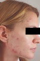 Laser Acne Treatment