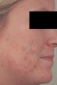 Laser Acne Treatment