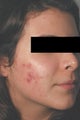 Laser Acne Treatment