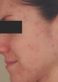Hormonal Acne Treatment in Los Angeles