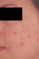 Laser Acne Treatment