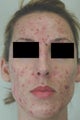Laser Acne Treatment