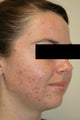 Laser Acne Treatment